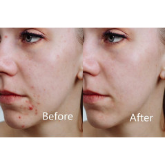 Aphrona LED facial mask, the ideal mask for your face