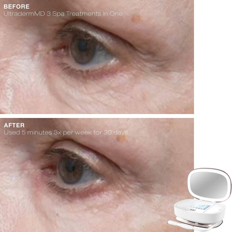 Trophy Skin UltradermMD: Microdermabrasion 3-en-1 à Domicile pour une Peau Éclatante!
