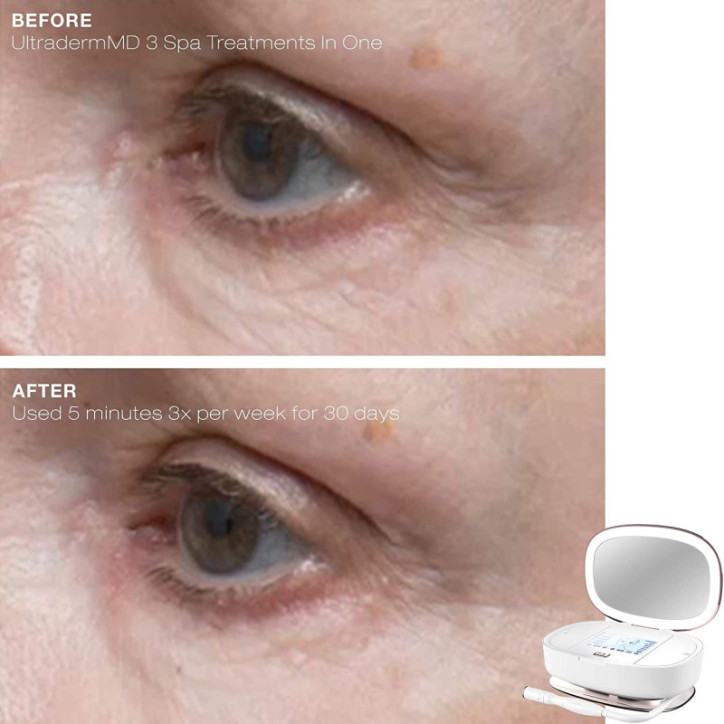 Trophy Skin UltradermMD: At-Home Microdermabrasion for Radiant, Youthful Skin