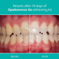 Opalescence Go 10 Mint: Whiten Your Smile Effortlessly! Prefilled Teeth Whitening Trays Opalescence Go 10 Mint: Whiten Your Smile Effortlessly! Prefilled Teeth Whitening Trays