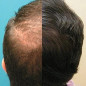 CapillusUltra Laser Hair Regrowth Cap: FDA-Cleared, Stop Hair Loss & Regrow Thicker Hair! CapillusUltra Laser Hair Regrowth Cap: FDA-Cleared, Stop Hair Loss & Regrow Thicker Hair!