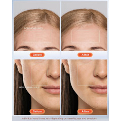 NEWKEY LED Face Mask Therapy for Wrinkles & Acne, 150 LEDs, Auto Off