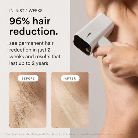 Nood™ NEW Flasher Pro IPL Laser Hair Removal & Anti-Aging Red Light Therapy Device – Pain-Free, Visible Results