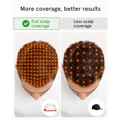 iRestore Pro 282 Lasers - Traitement FDA Contre Perte de Cheveux