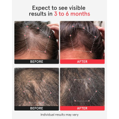 iRestore Pro 282 Lasers - Traitement FDA Contre Perte de Cheveux