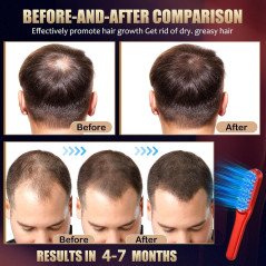 Peigne Laser Croissance Cheveux Rouge - Traitement Homme & Femme