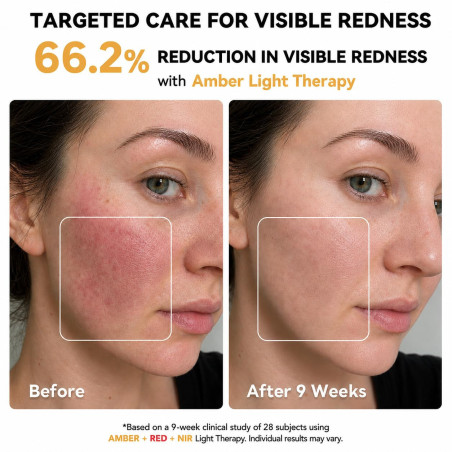 FDA-Cleared Blue Light Mask & Red Light Therapy for Face Acne Care