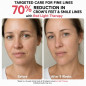 FDA-Cleared Red & Blue Light Therapy Mask for Face Acne Treatment