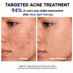 FDA-Cleared Blue Light Mask & Red Light Therapy for Face Acne Care