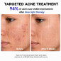 FDA-Cleared Red & Blue Light Therapy Mask for Face Acne Treatment